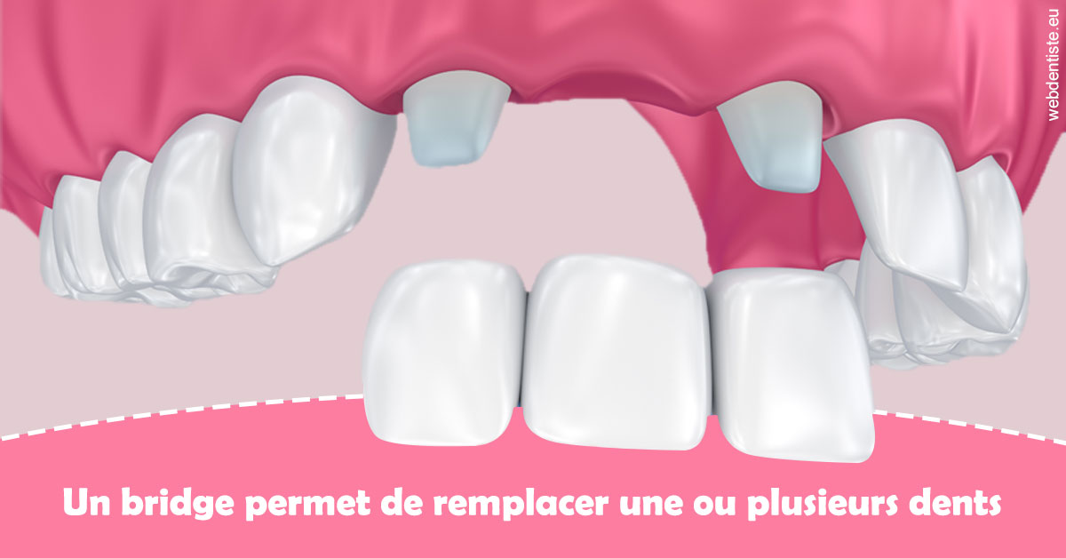 https://dr-jean-luc-vouillot.chirurgiens-dentistes.fr/Bridge remplacer dents 2