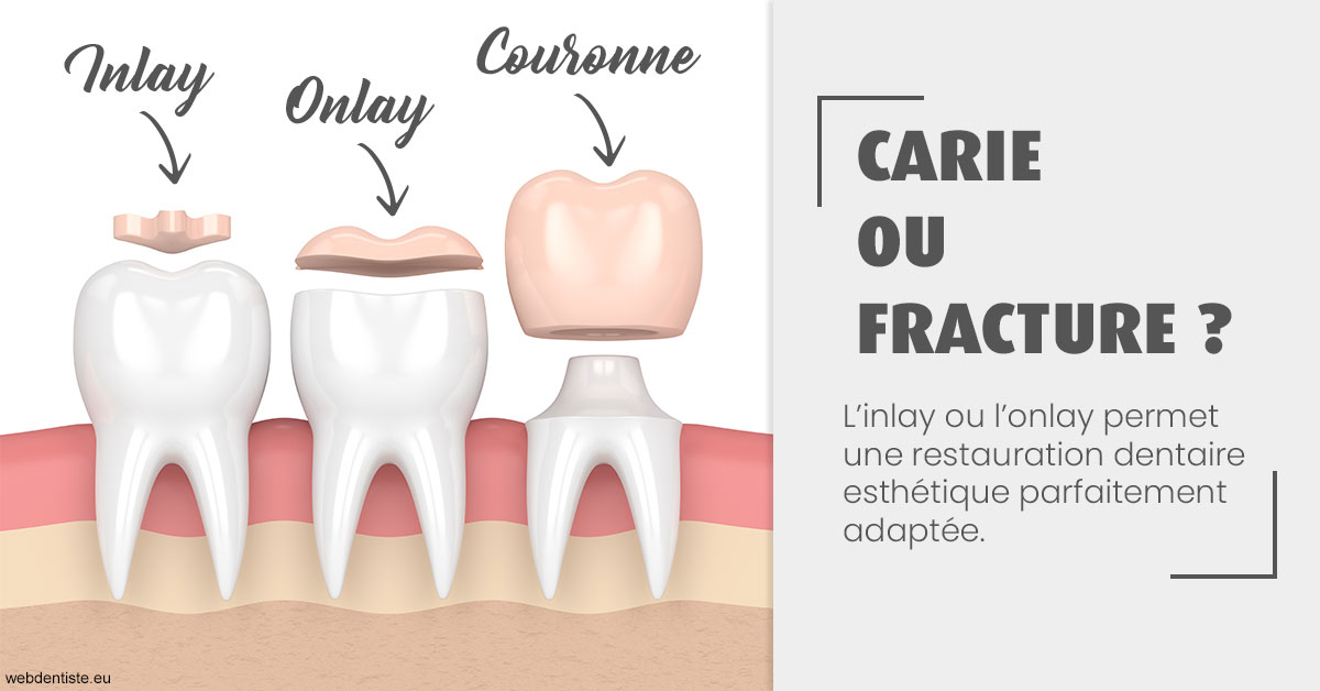 https://dr-jean-luc-vouillot.chirurgiens-dentistes.fr/T2 2023 - Carie ou fracture 1