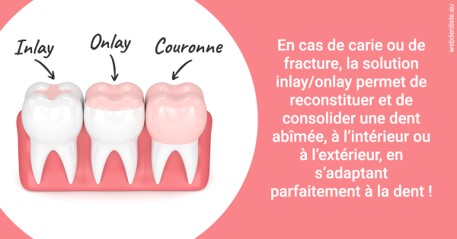 https://dr-jean-luc-vouillot.chirurgiens-dentistes.fr/L'INLAY ou l'ONLAY 2