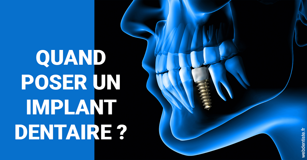 https://dr-jean-luc-vouillot.chirurgiens-dentistes.fr/Les implants 1