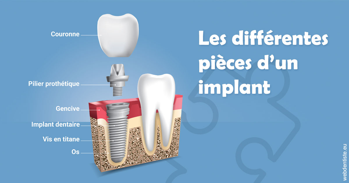 https://dr-jean-luc-vouillot.chirurgiens-dentistes.fr/Les différentes pièces d’un implant 1